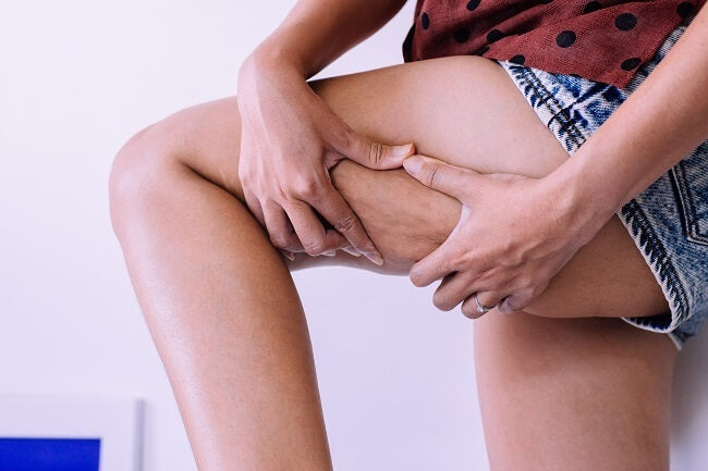 Cellulite: wat is het en hoe kom je eraan?